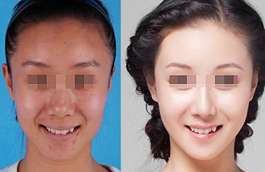 皮秒治療做完后要多久見(jiàn)效？